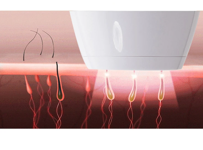 Depilador Laser IPL Permanente