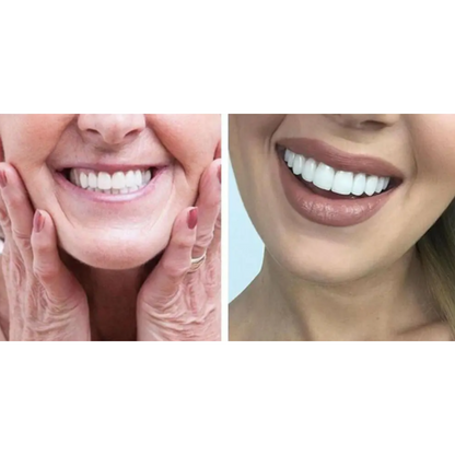 Carillas Dentales Sonrisa Blanca Natural